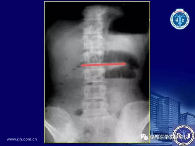 【PPT】绞窄性肠梗阻CT诊断