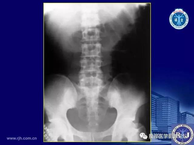 【PPT】绞窄性肠梗阻CT诊断