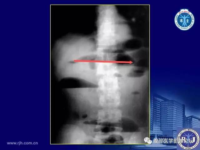 【PPT】绞窄性肠梗阻CT诊断
