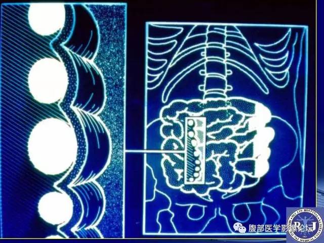 【PPT】绞窄性肠梗阻CT诊断