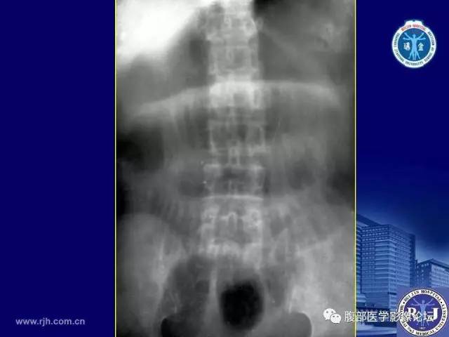 【PPT】绞窄性肠梗阻CT诊断
