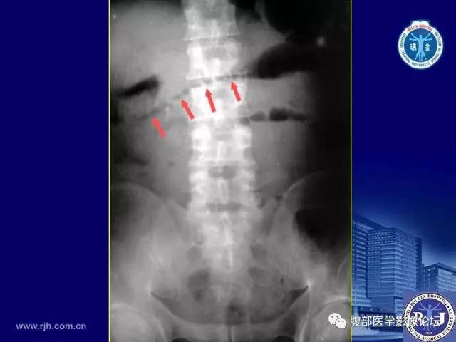 【PPT】绞窄性肠梗阻CT诊断