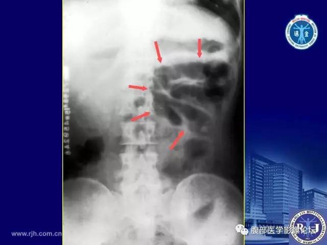 【PPT】绞窄性肠梗阻CT诊断