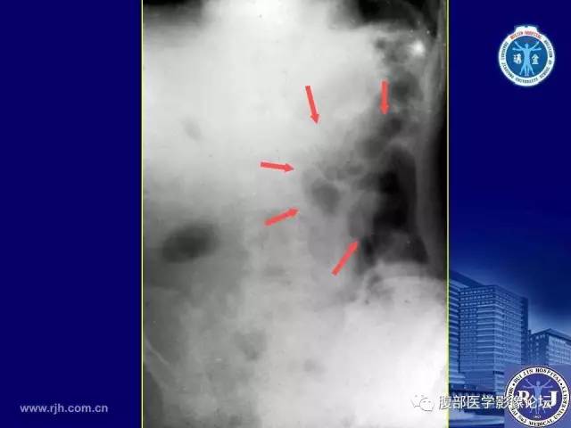 【PPT】绞窄性肠梗阻CT诊断