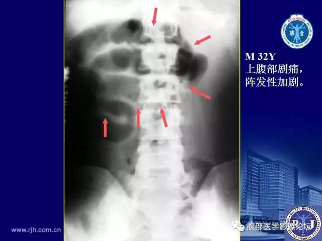 【PPT】绞窄性肠梗阻CT诊断
