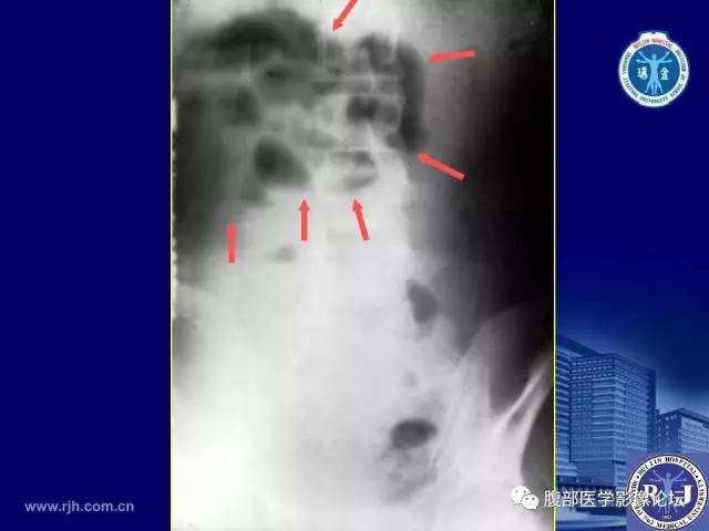 【PPT】绞窄性肠梗阻CT诊断