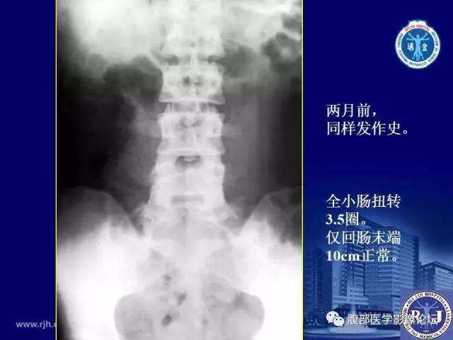 【PPT】绞窄性肠梗阻CT诊断