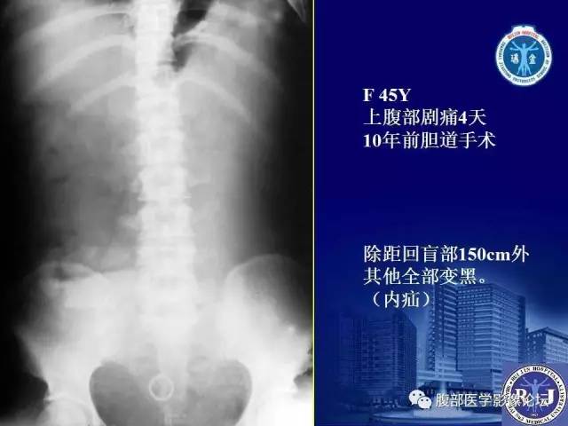 【PPT】绞窄性肠梗阻CT诊断