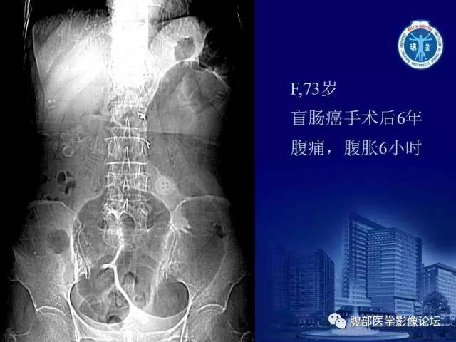 【PPT】绞窄性肠梗阻CT诊断