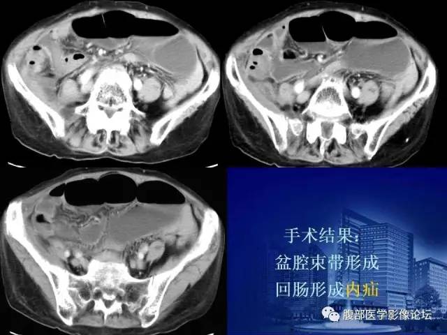 【PPT】绞窄性肠梗阻CT诊断