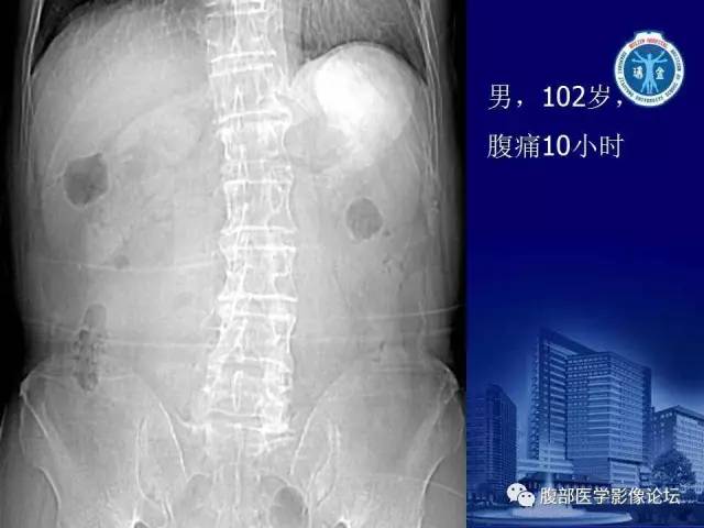 【PPT】绞窄性肠梗阻CT诊断