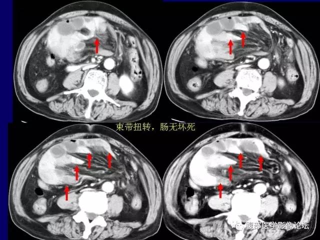 【PPT】绞窄性肠梗阻CT诊断