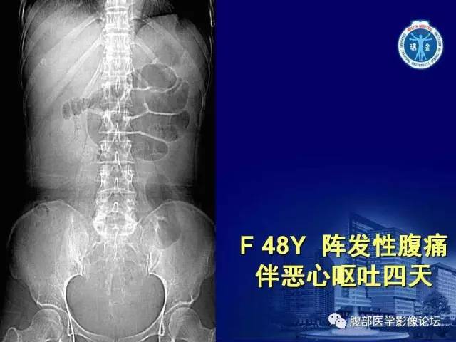【PPT】绞窄性肠梗阻CT诊断