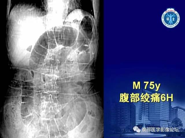 【PPT】绞窄性肠梗阻CT诊断