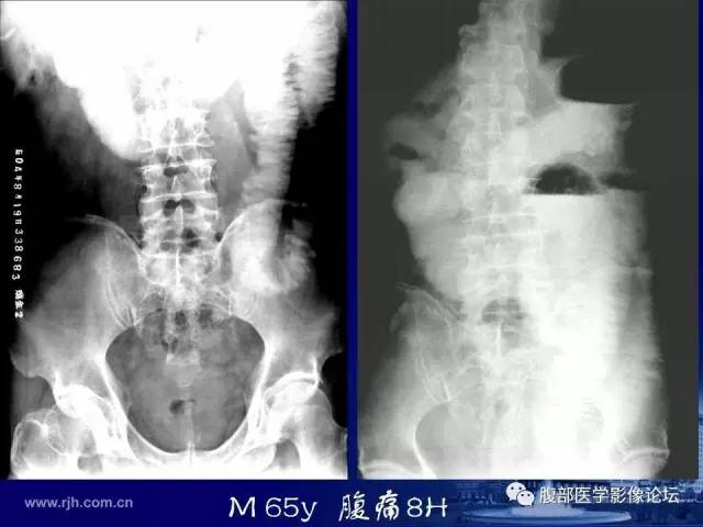 【PPT】绞窄性肠梗阻CT诊断