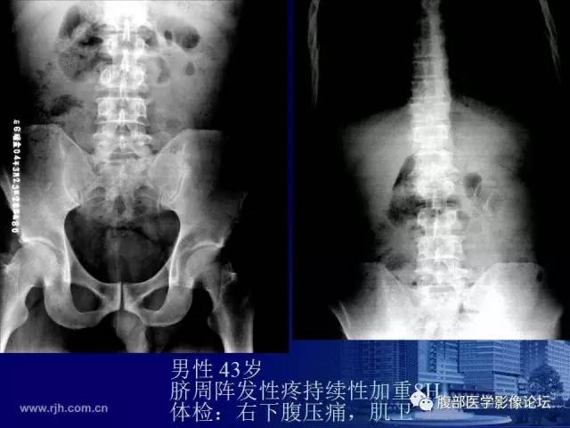 【PPT】绞窄性肠梗阻CT诊断
