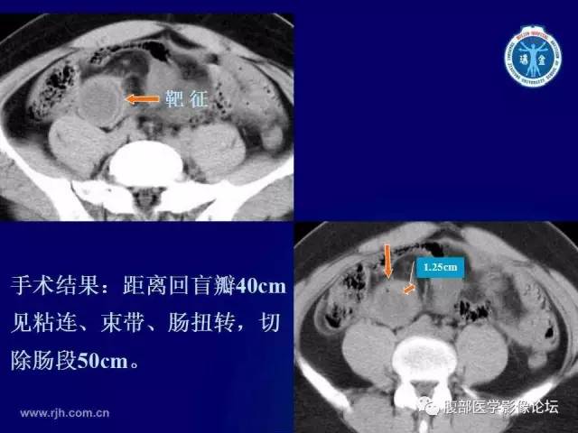 【PPT】绞窄性肠梗阻CT诊断