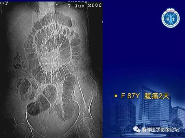 【PPT】绞窄性肠梗阻CT诊断
