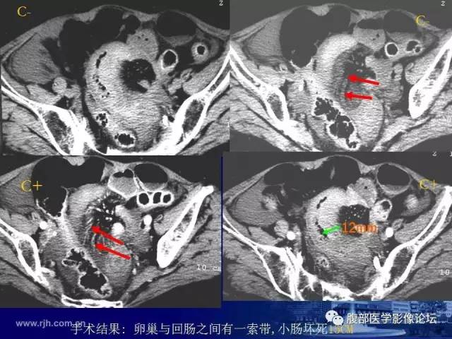 【PPT】绞窄性肠梗阻CT诊断