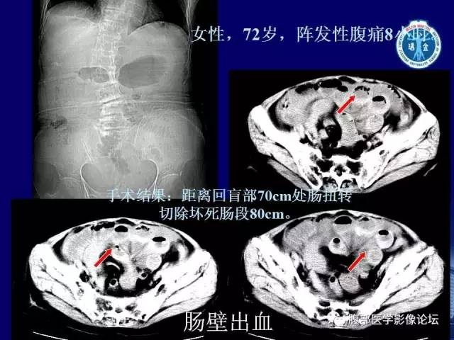 【PPT】绞窄性肠梗阻CT诊断