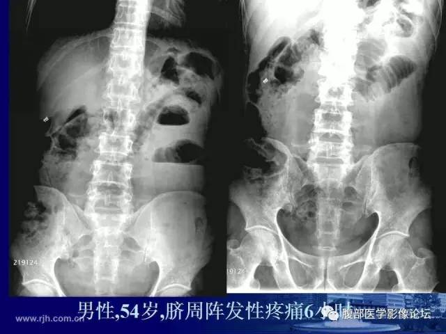 【PPT】绞窄性肠梗阻CT诊断