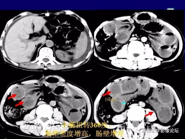 【PPT】绞窄性肠梗阻CT诊断