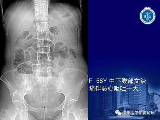 【PPT】绞窄性肠梗阻CT诊断