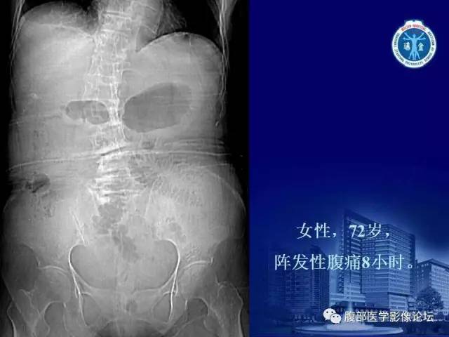 【PPT】绞窄性肠梗阻CT诊断