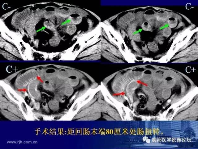 【PPT】绞窄性肠梗阻CT诊断