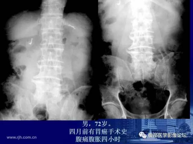 【PPT】绞窄性肠梗阻CT诊断