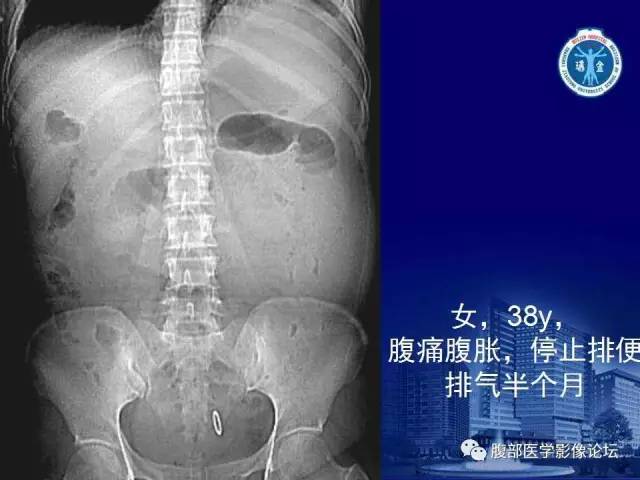 【PPT】绞窄性肠梗阻CT诊断