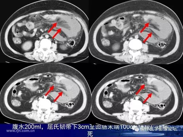 【PPT】绞窄性肠梗阻CT诊断