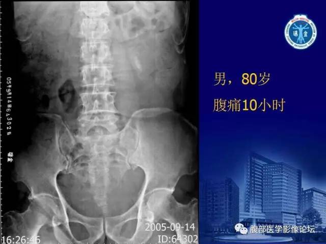 【PPT】绞窄性肠梗阻CT诊断