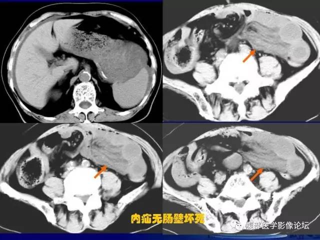 【PPT】绞窄性肠梗阻CT诊断