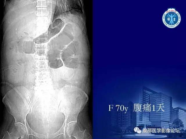 【PPT】绞窄性肠梗阻CT诊断