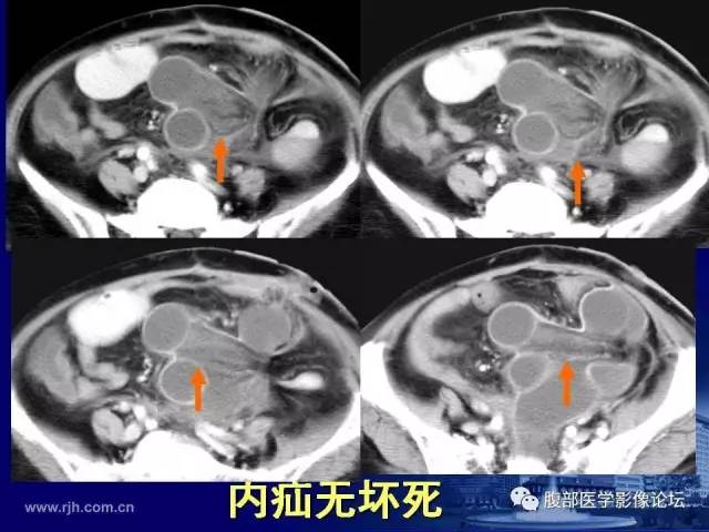 【PPT】绞窄性肠梗阻CT诊断