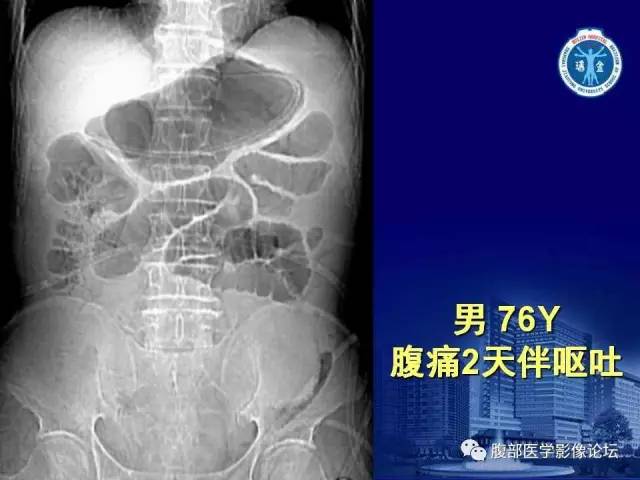 【PPT】绞窄性肠梗阻CT诊断