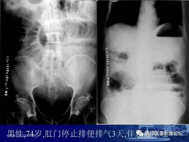 【PPT】绞窄性肠梗阻CT诊断