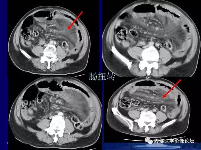 【PPT】绞窄性肠梗阻CT诊断