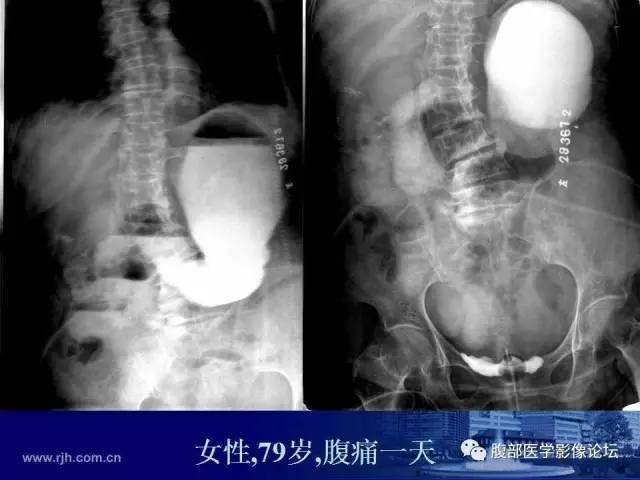 【PPT】绞窄性肠梗阻CT诊断