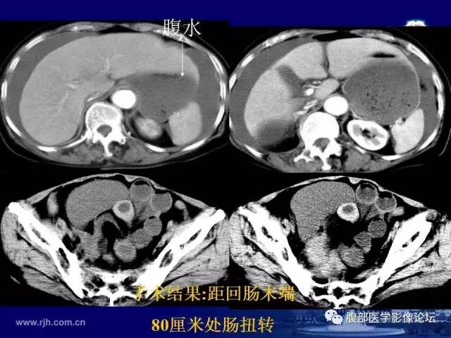 【PPT】绞窄性肠梗阻CT诊断