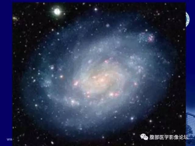 【PPT】绞窄性肠梗阻CT诊断
