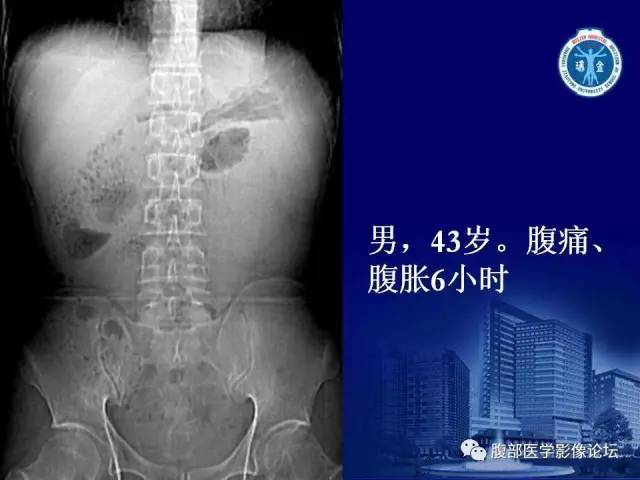 【PPT】绞窄性肠梗阻CT诊断