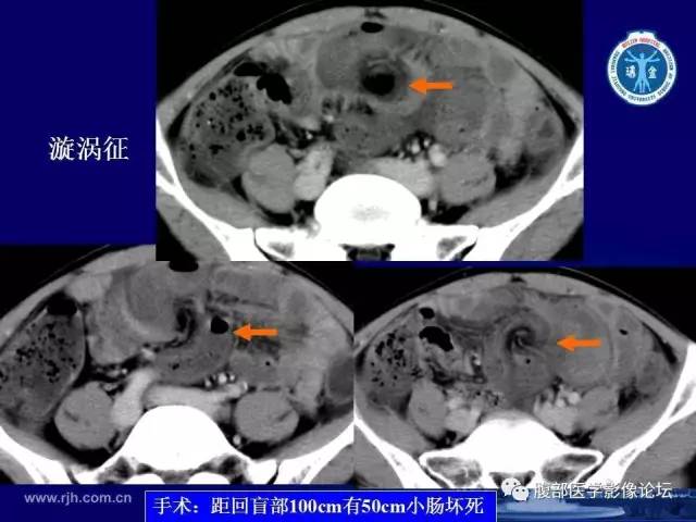 【PPT】绞窄性肠梗阻CT诊断