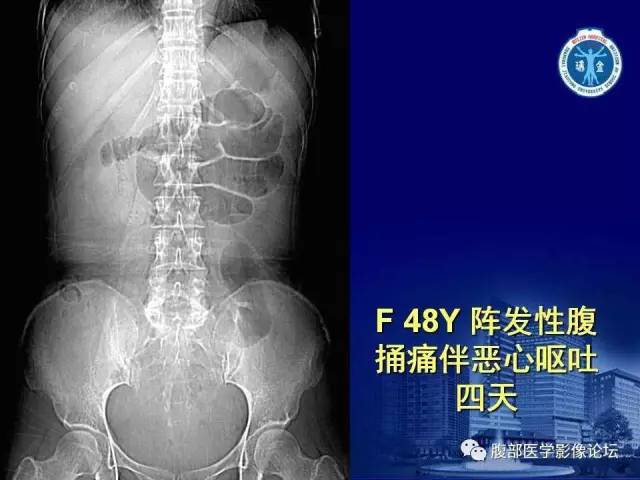 【PPT】绞窄性肠梗阻CT诊断