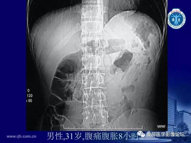 【PPT】绞窄性肠梗阻CT诊断