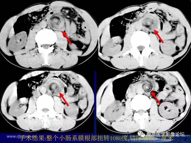 【PPT】绞窄性肠梗阻CT诊断