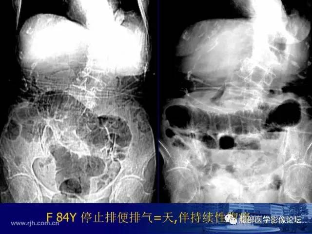 【PPT】绞窄性肠梗阻CT诊断