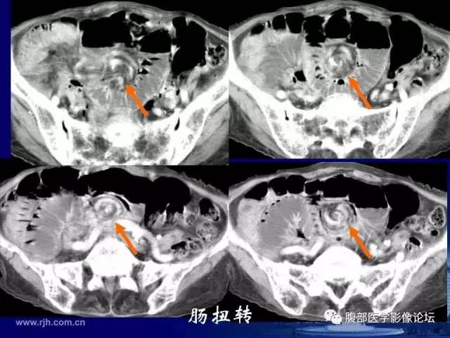 【PPT】绞窄性肠梗阻CT诊断