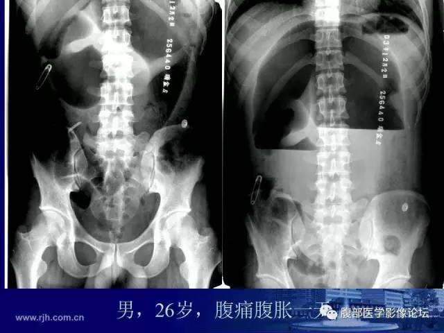 【PPT】绞窄性肠梗阻CT诊断